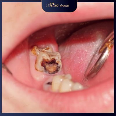 Sâu răng là bệnh lý răng miệng thường gặp