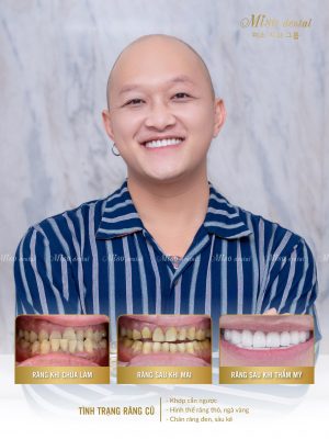 Sự thay đổi tuyệt vời của Hoàng Du Ka sau khi làm răng tại Miso Dental