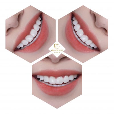 Hàm răng của Hàn Trang sau khi dán sứ Veneer